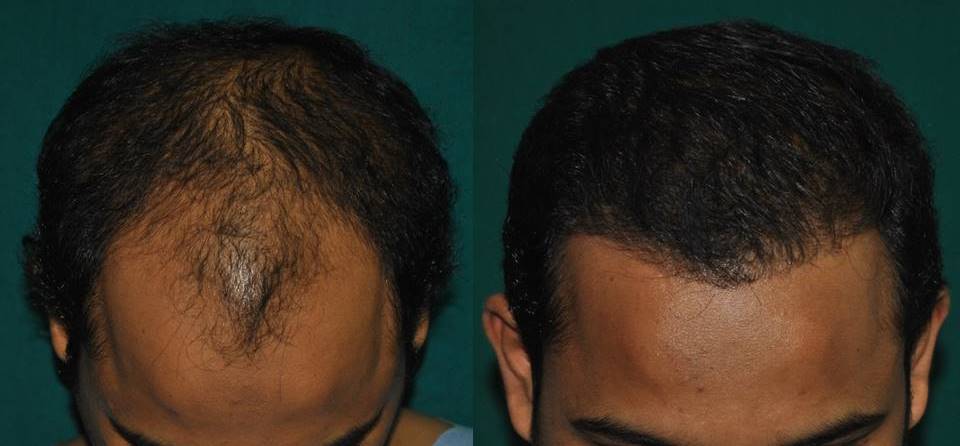 Hair transplant in Ernakulam by FUT
